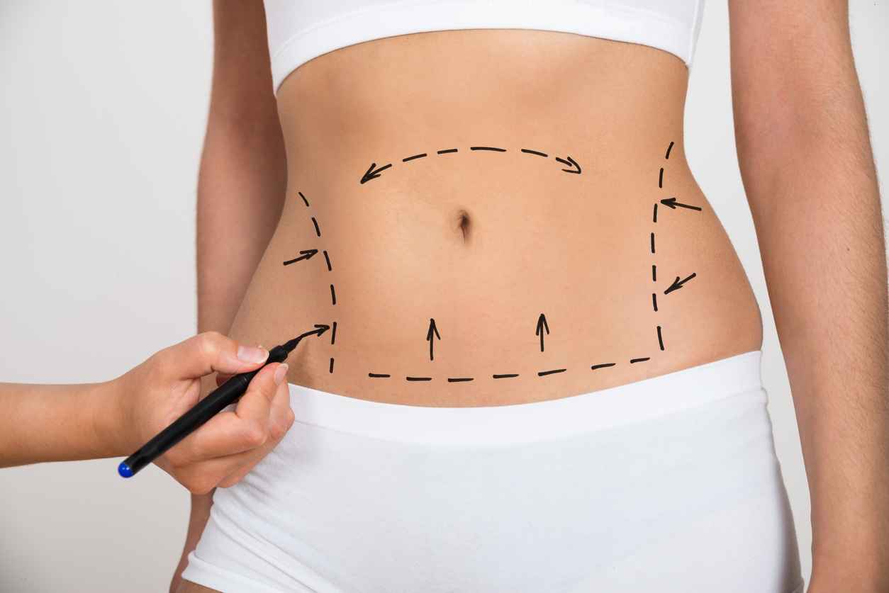 Featured image for “Liposuction Recovery: Tips for a Smooth Healing Process”