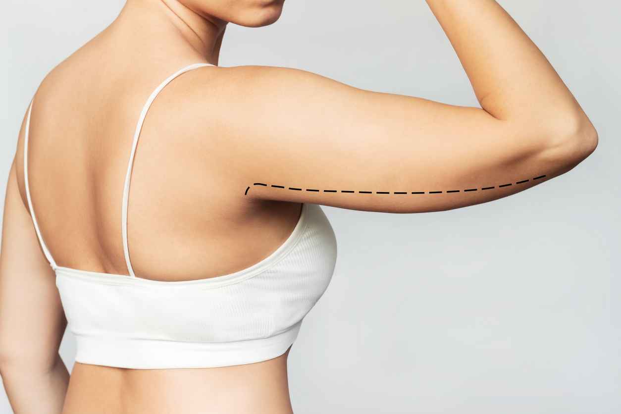 Cropped shot of a young woman with excess fat on her upper arm with marks for liposuction or plastic surgery isolated on a gray background. Loose and saggy muscles. Overweight. Beauty surgery concept; Cropped shot of a young woman with excess fat on her upper arm with marks for liposuction or plastic surgery isolated on a gray background. Loose and saggy muscles. Overweight. Beauty surgery concept; Myths About Liposuction