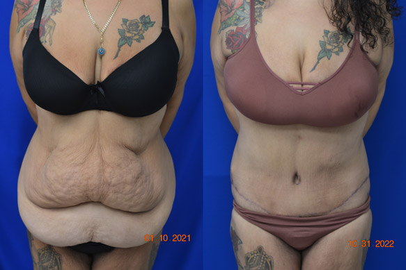 Andochick-Abdominoplasty-Before-After-5