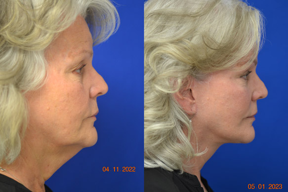 Facelift-Before-After-Dr-Andochick-1