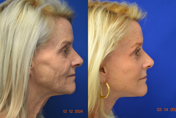 Facelift-Before-After-Dr-Andochick-11