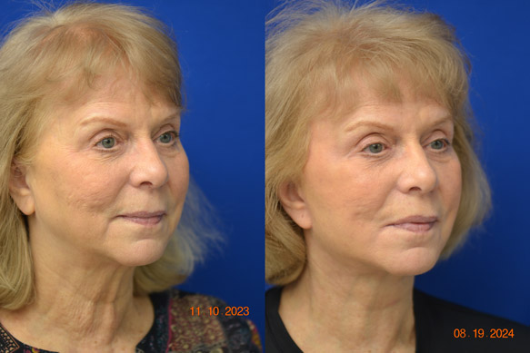 Facelift-Before-After-Dr-Andochick-4