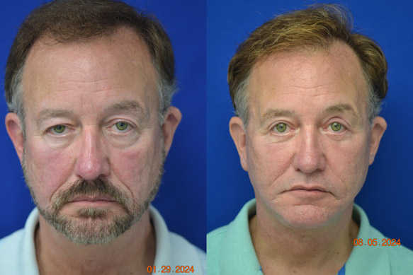Facelift-Before-After-Dr-Andochick-5