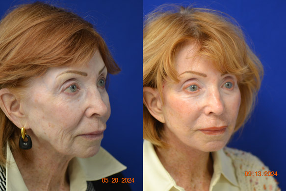 Facelift-Before-After-Dr-Andochick-6