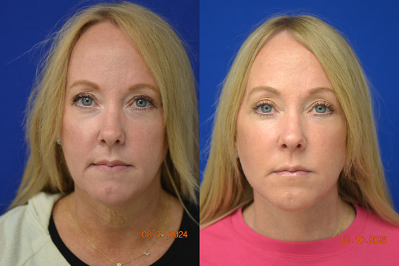 Facelift-Before-After-Dr-Andochick-7