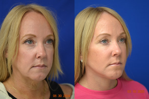 Facelift-Before-After-Dr-Andochick-8