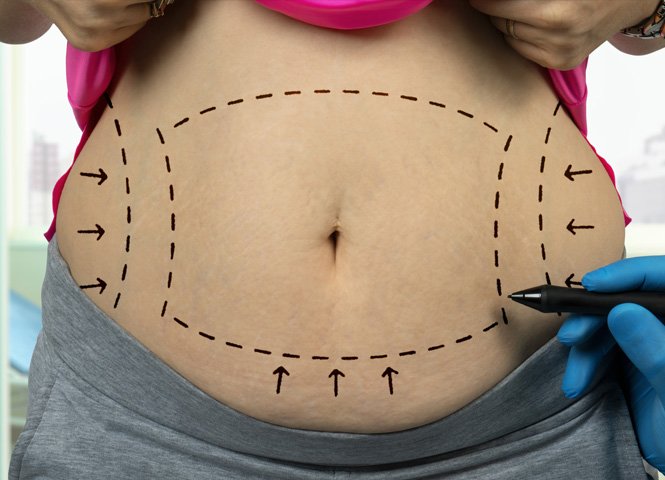 1763749019_tummytuck-2 1763749019 tummytuck 2 1