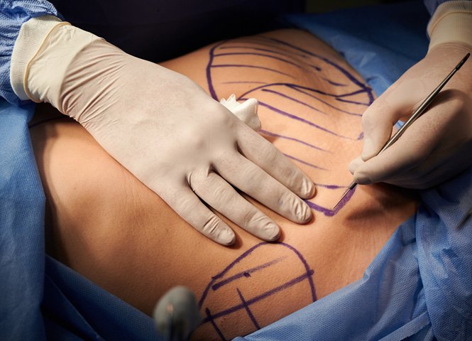 1763749028_tummy-tuck-1 1763749028 tummy tuck 1 1